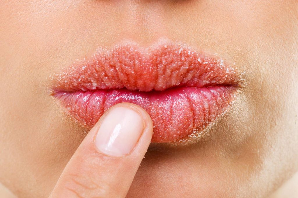 How To Get Rid Of Chapped And Cracked Lips 5260