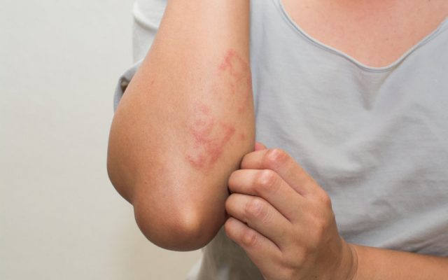 Eczema on Arms and Hands? Treat it Effectively!